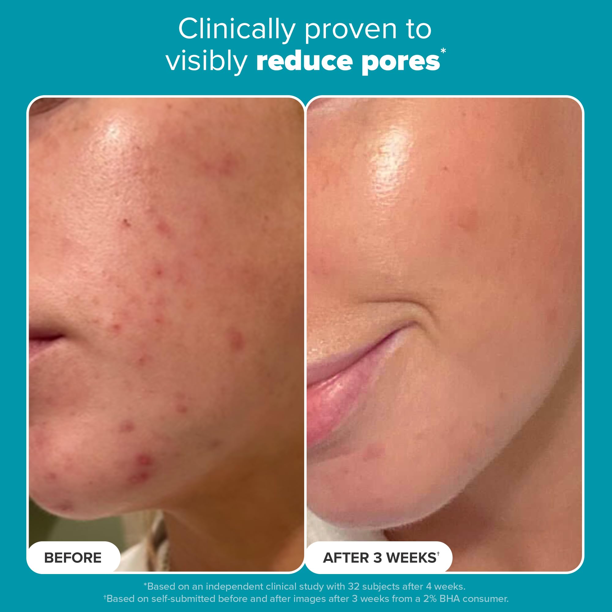 Paula's Choice Exfoliant